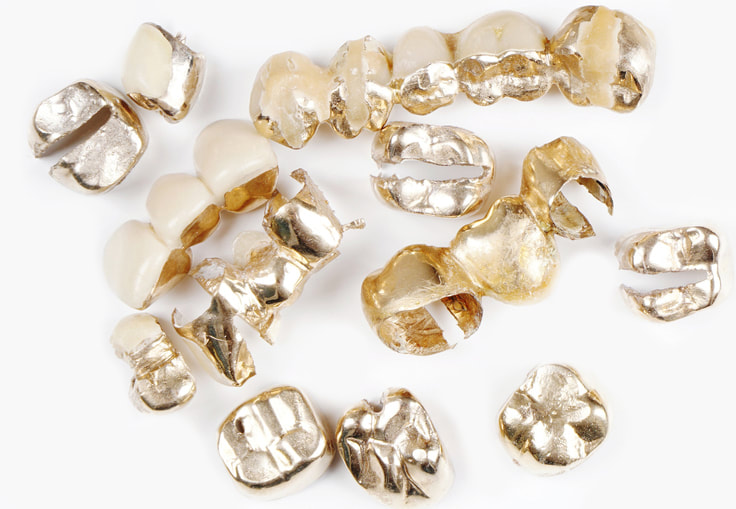 value of dental gold